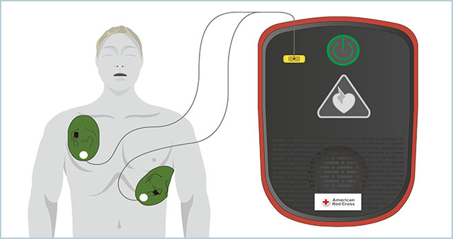 AED Pad Placement infographic on an Adult CPR Manikin.